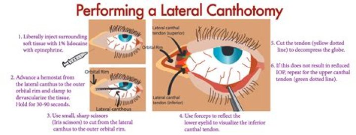 What is a lateral Canthotomy?