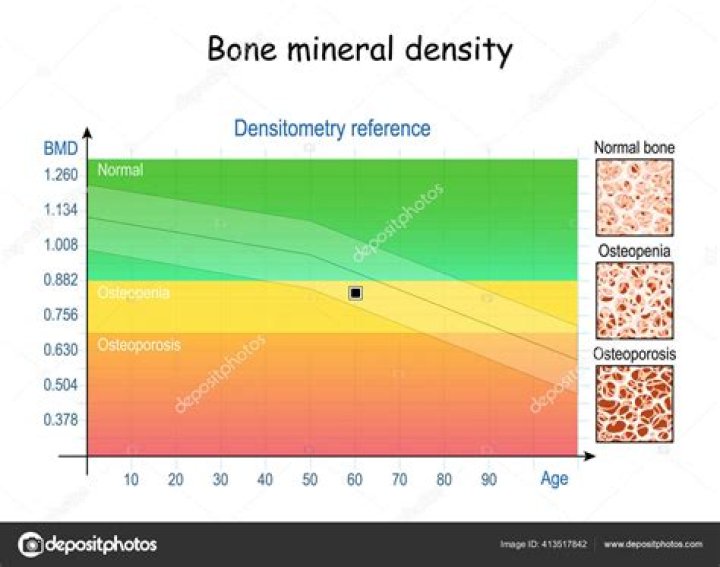 What is a normal bone mineral density score?