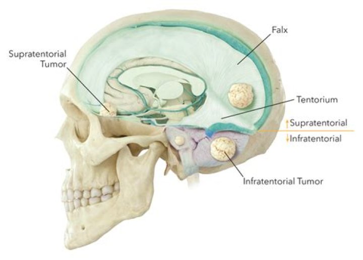 What is a Supratentorial tumor