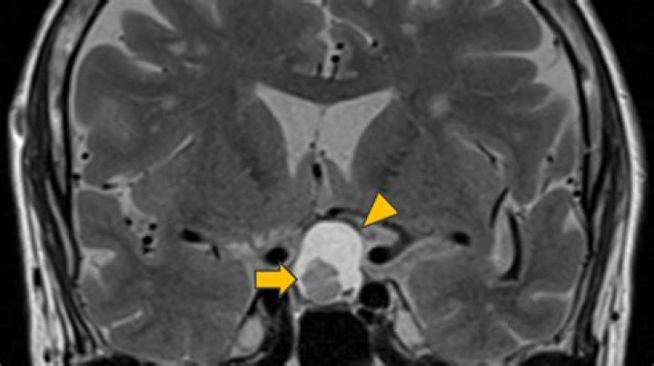 What is an intermedia cyst?