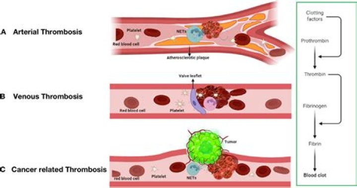 What is bland thrombosis?