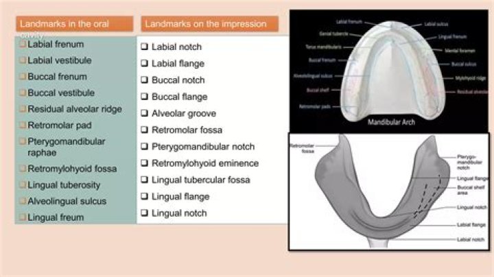 What is edentulous arch?