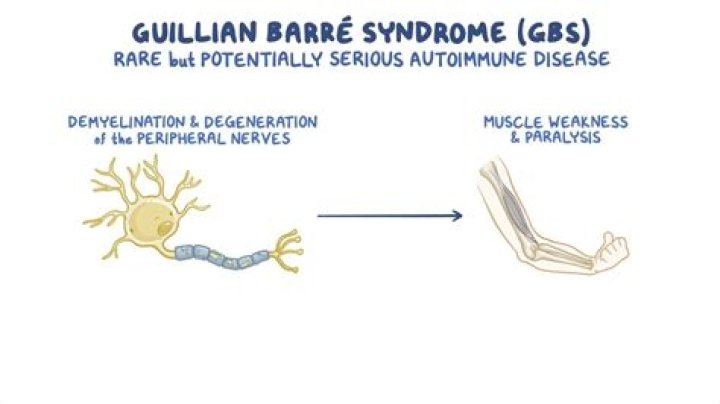 What is fulminant Guillain-Barre Syndrome?