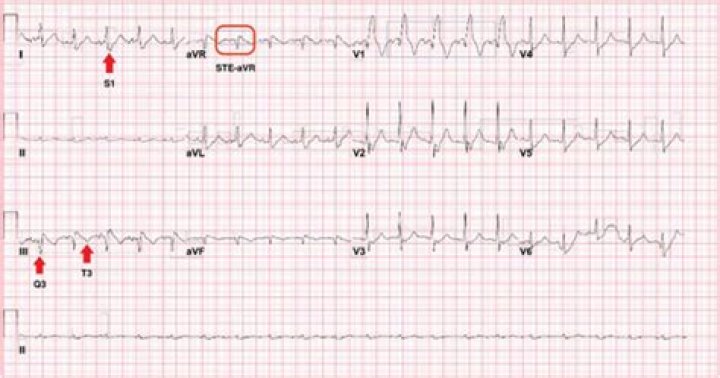 What is McGinn-White Sign?
