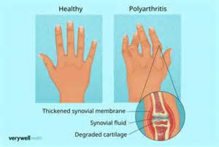 What is migratory Polyarthralgia?