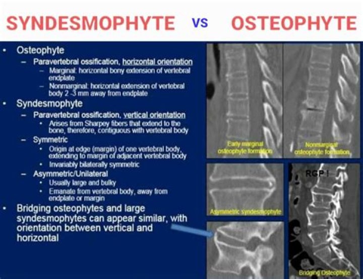 What is minimal osteophyte formation?