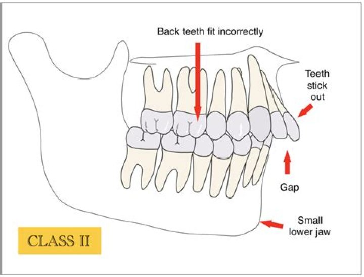 What is severe malocclusion? | ContextResponse.com