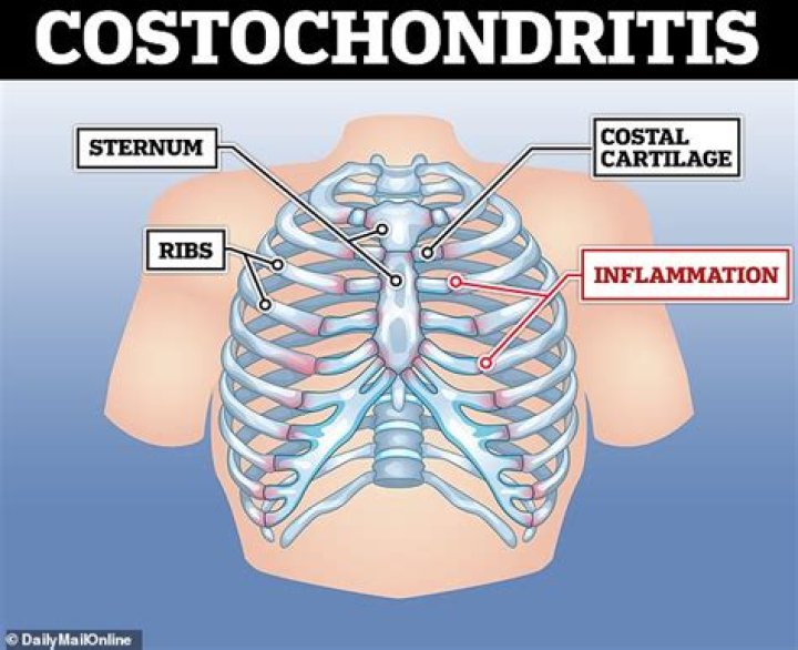 What is the difference between costochondritis and Tietze syndrome?