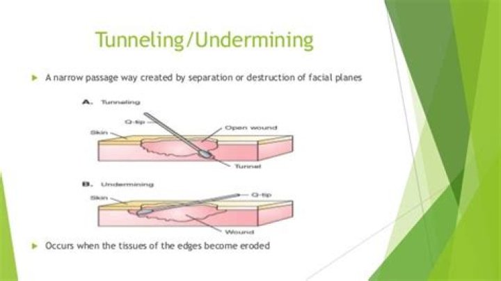 What is the difference between undermining and tunneling