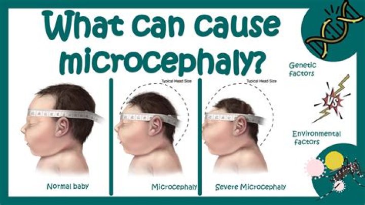 What is the life expectancy of microcephaly?