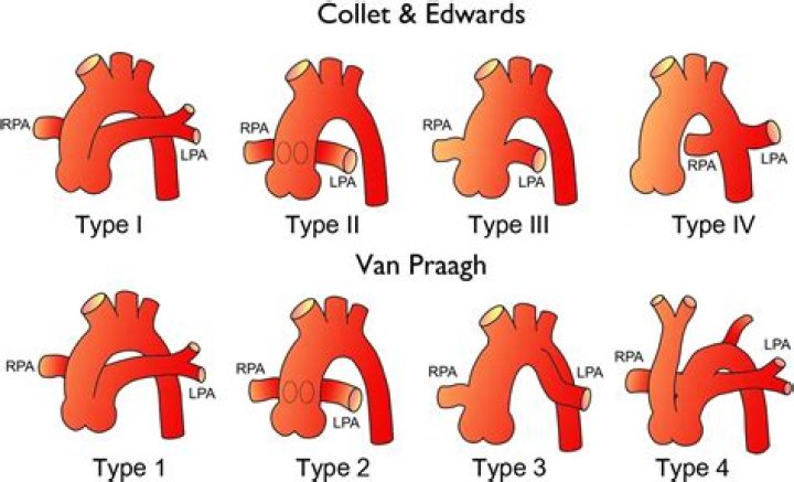 What is the most common type of truncus arteriosus?