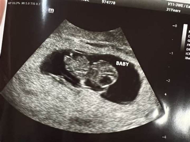 What should I expect at my 21 week ultrasound?