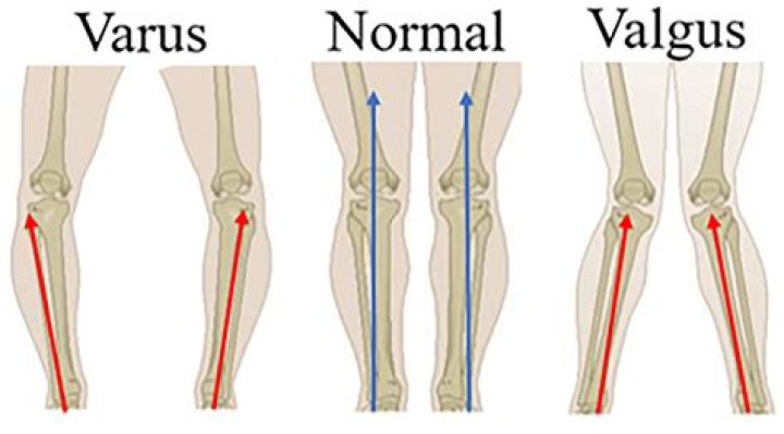Which of the following can increase the severity of genu Valgum?