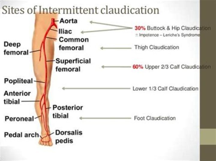 Which of the following conditions causes intermittent claudication?