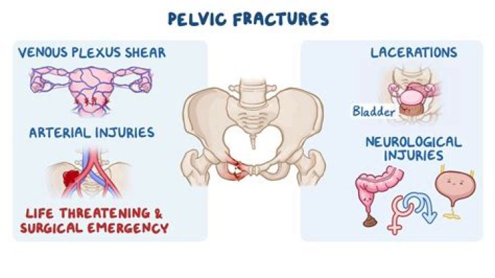 Which type of injury is associated with pelvic fractures?