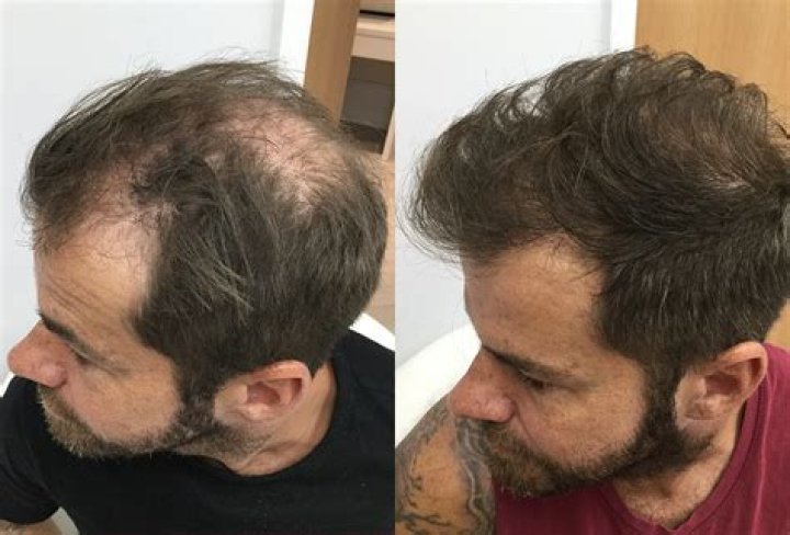 Will my hair grow back after stopping amlodipine?